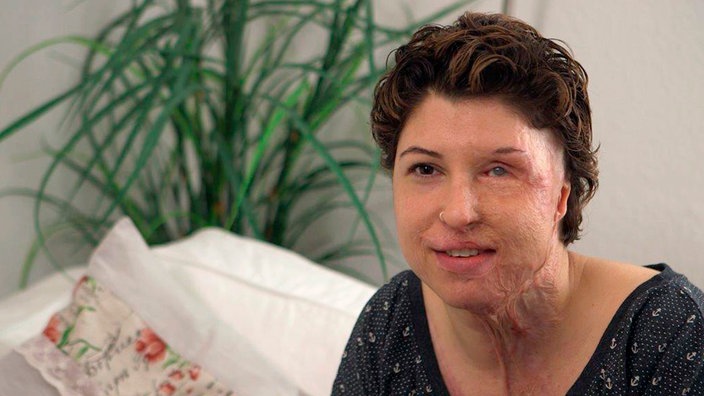 Vanessa wurde Opfer eines Säureattentats | Bildquelle: WDR Vanessa wurde Opfer eines Säureattentats