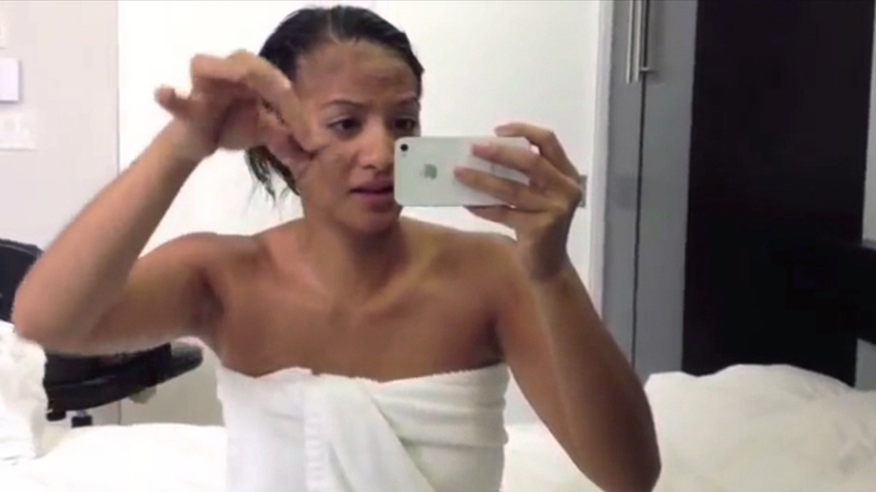 YouTuberin Nalie filmt ihre Haarbüschel nach der Chemo